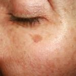 Understanding Causes and Options for Liver Spots Natural Treatment