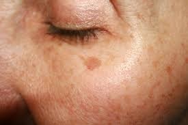 Understanding Causes and Options for Liver Spots Natural Treatment